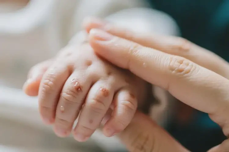 孩子身上偶爾起濕疹不管它會(huì)自己好嗎(圖3)