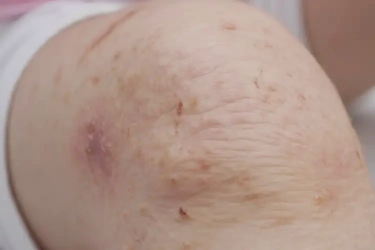 孩子小腿出濕疹能靠自己自愈嗎(圖4)