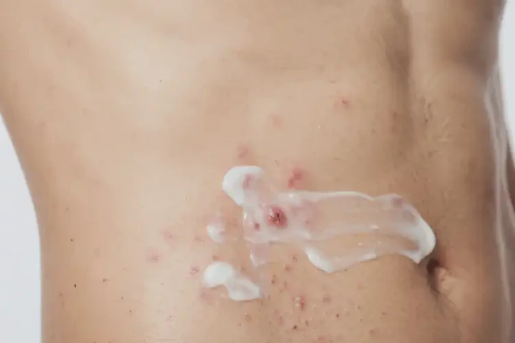 青年人肚子上起濕疹能夠徹底治愈嗎(圖3)