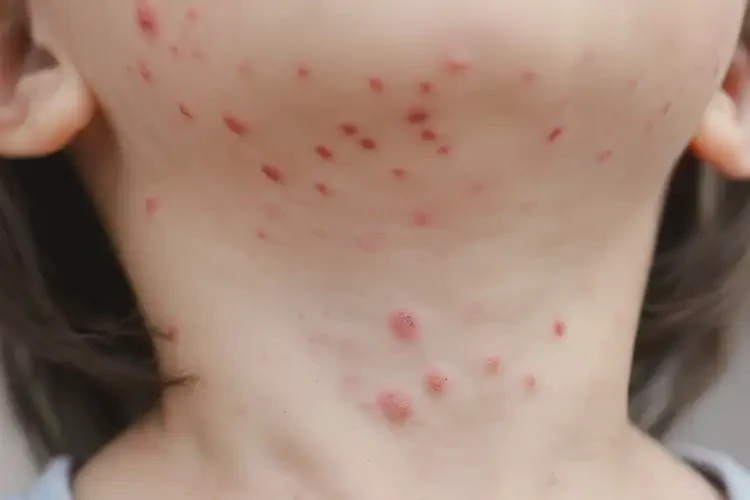 兒童脖子起濕疹可不可以根治(圖4)
