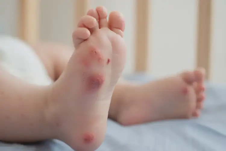 少兒腳上長(zhǎng)濕疹不管它會(huì)自己好嗎(圖1)