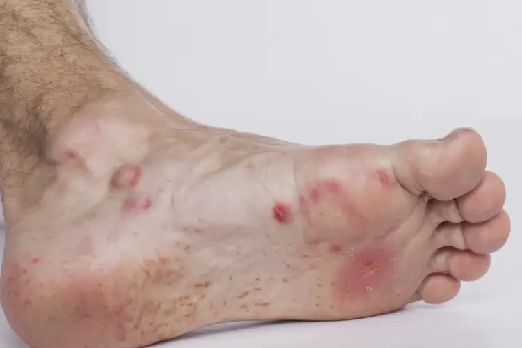 男人腳上出濕疹能不能根治(圖4)
