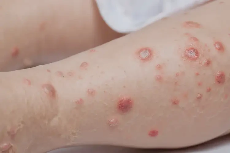 少兒小腿上起濕疹能夠徹底治愈嗎(圖4)