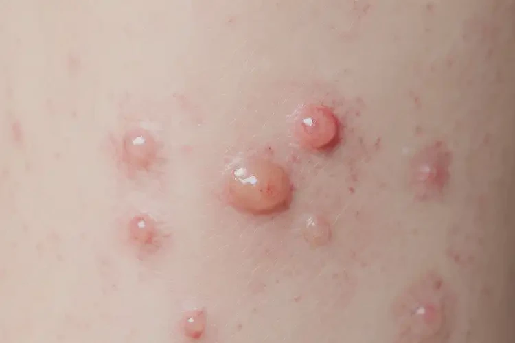 男性四肢長濕疹能徹底自愈嗎(圖4)