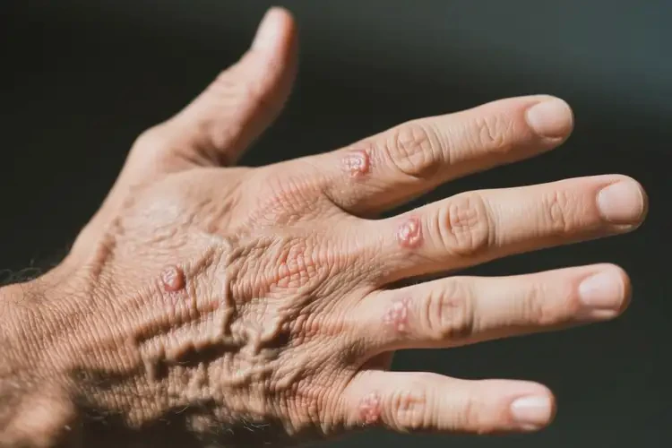 男人手上長(zhǎng)濕疹能徹底自愈嗎(圖4)