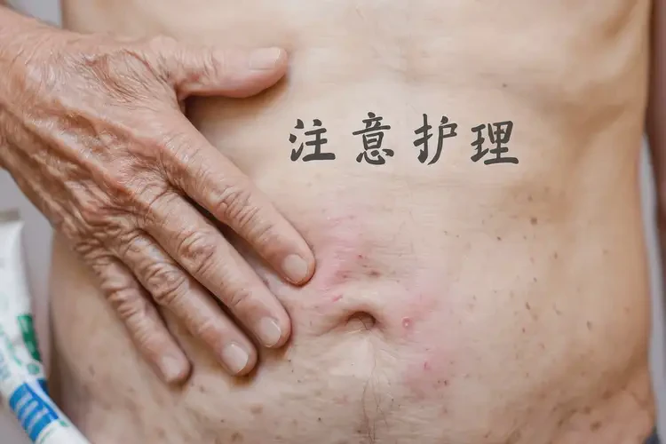 老年人肚子上偶爾長(zhǎng)濕疹不管它會(huì)自己自愈嗎(圖4)