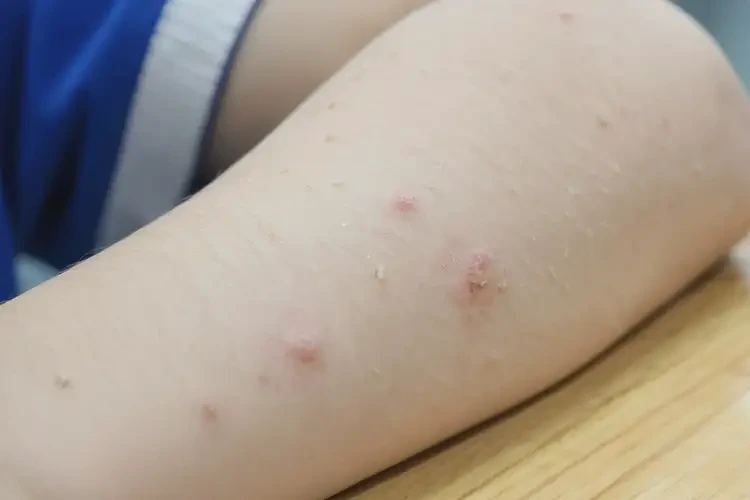 小學(xué)生手臂長濕疹不管它會自己好嗎(圖4)