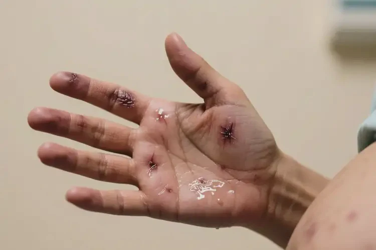 產(chǎn)婦手上經(jīng)常長濕疹不管它會自己痊愈嗎(圖1)