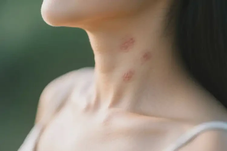 產(chǎn)婦脖子有濕疹不管它會自己好嗎(圖4)