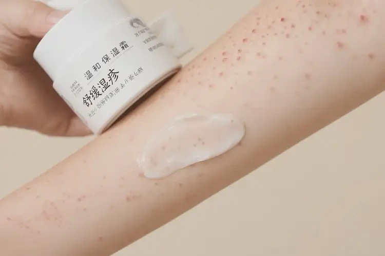 女性手臂偶爾長濕疹可以徹底自愈嗎(圖3)