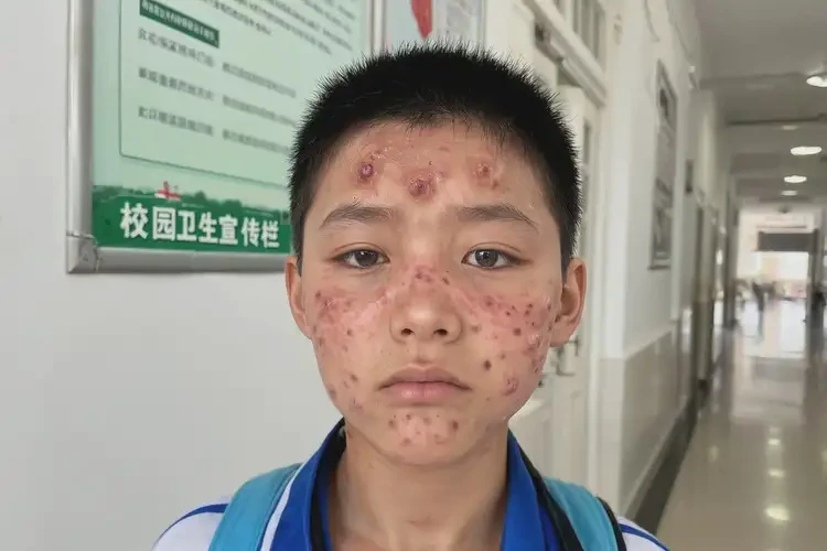 中學(xué)生面部有濕疹能不能徹底自愈(圖4)