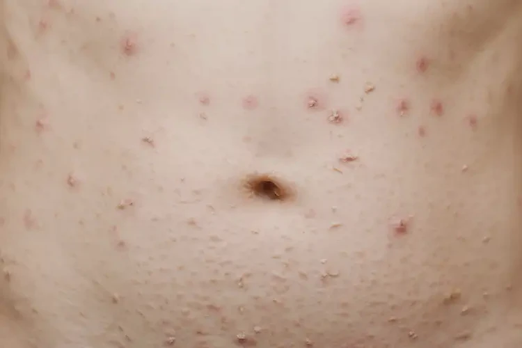 青少年肚子出濕疹可不可以徹底自愈(圖4)