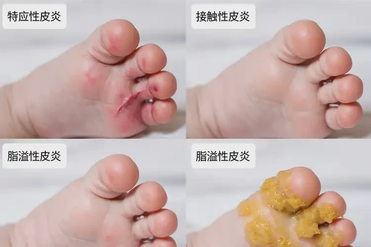 嬰兒腳上有濕疹能夠徹底治愈嗎(圖1)