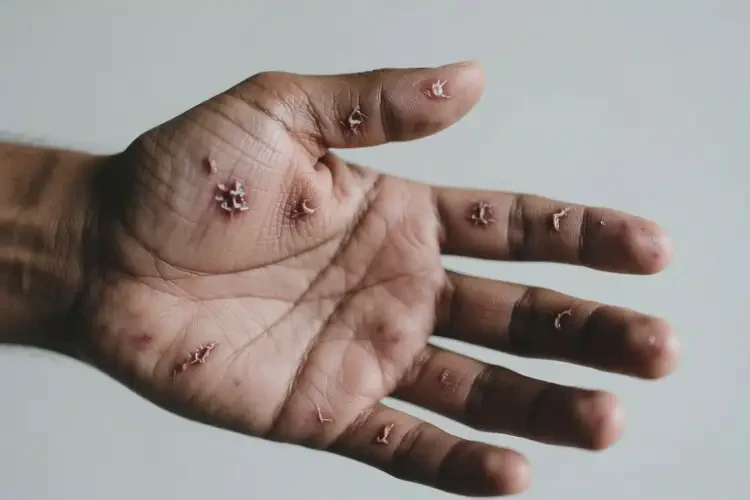 男性手上起濕疹能靠自己自愈嗎(圖1)