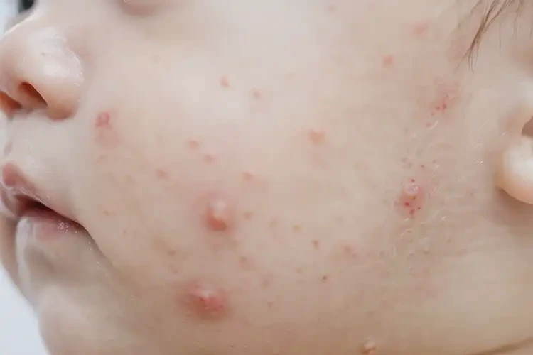 小孩屁股經(jīng)常長濕疹可不可以根治(圖4)