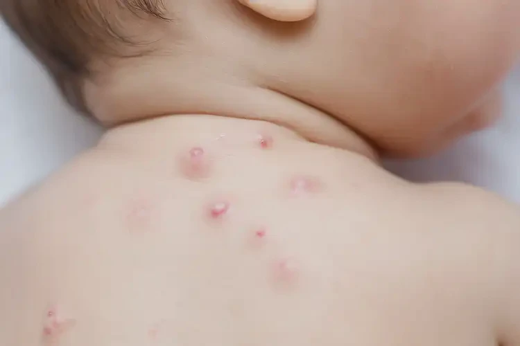 寶寶脖子有濕疹可不可以根治(圖4)