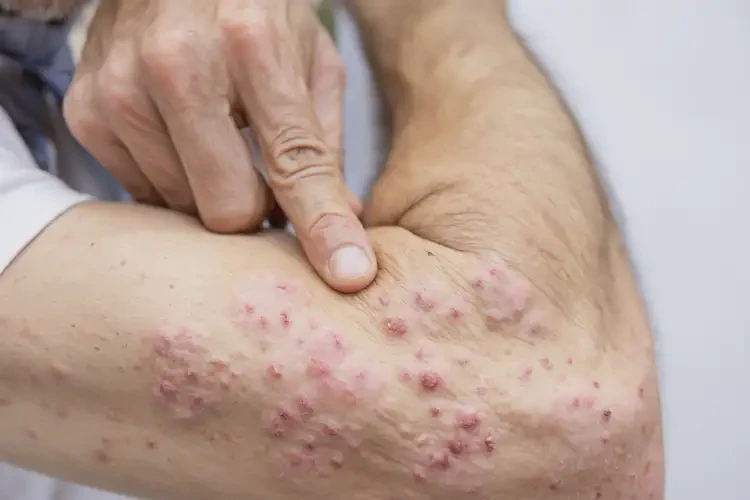 男人四肢经常长湿疹能不能彻底自愈(图4)