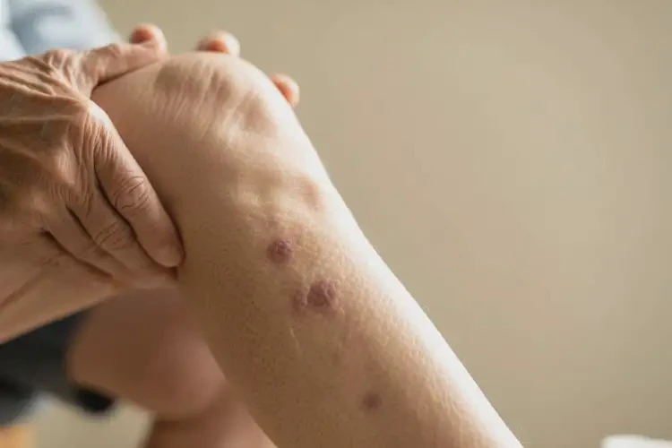 老人大腿出濕疹能徹底自愈嗎(圖1)