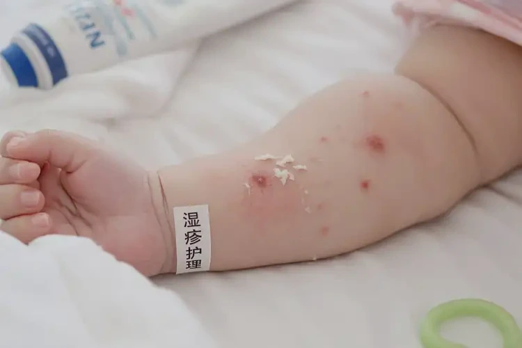嬰兒手臂上經(jīng)常長濕疹可不可以根治(圖4)