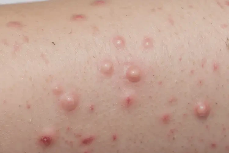 青少年屁股上偶爾起濕疹能靠自己自愈嗎(圖4)