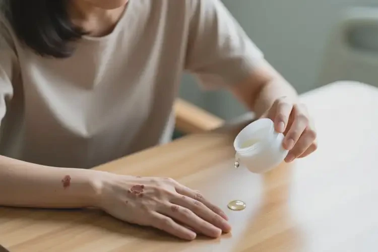 女人手上偶爾起濕疹能不能根治(圖3)