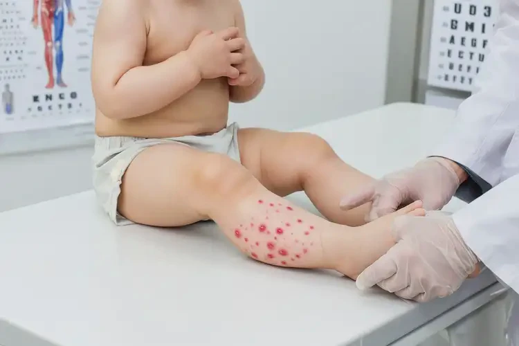 幼兒大腿經(jīng)常起濕疹可不可以根治(圖4)