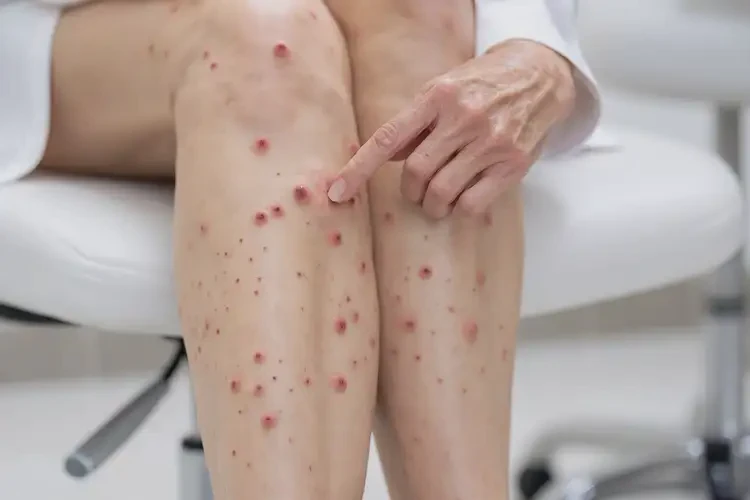 女生小腿出濕疹不管它會(huì)自己痊愈嗎(圖4)