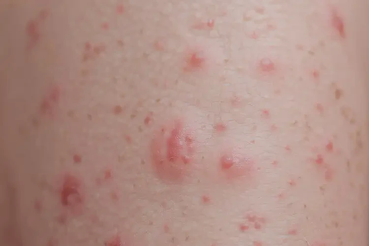 新生兒小腿容易長濕疹可不可以根治(圖4)