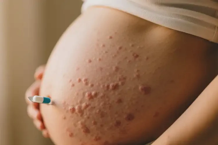 產(chǎn)婦身上出現(xiàn)濕疹可不可以根治(圖3)