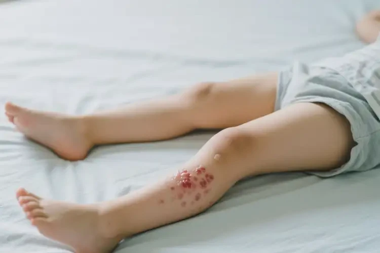 孩子大腿容易起湿疹可以彻底自愈吗(图3)