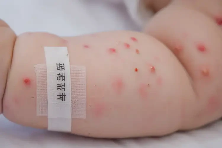 嬰兒手臂上有濕疹可不可以根治(圖4)