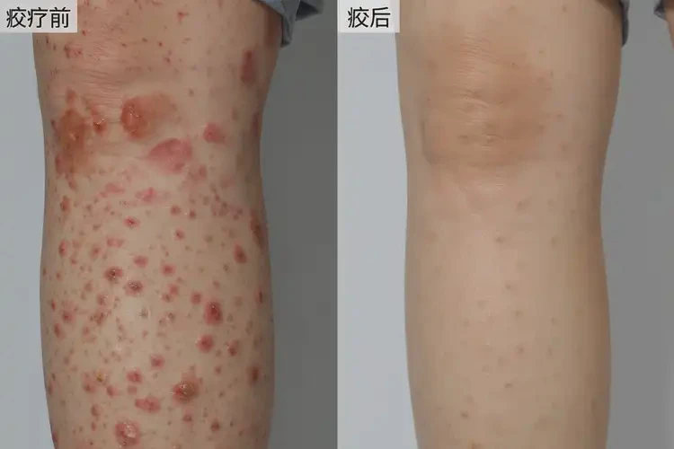 女生小腿出濕疹不管它會(huì)自己痊愈嗎(圖1)