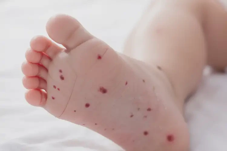 寶寶腳上出濕疹可不可以根治(圖4)