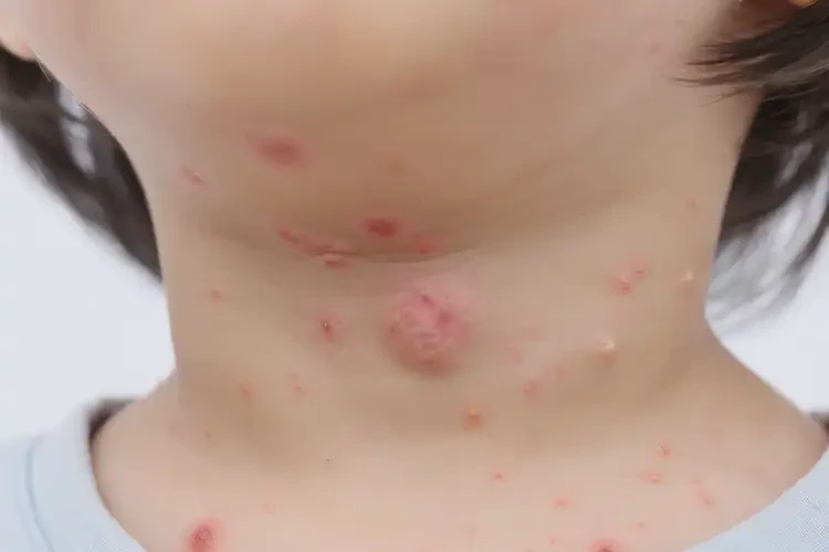 小兒脖子偶爾長(zhǎng)濕疹可不可以根治(圖4)