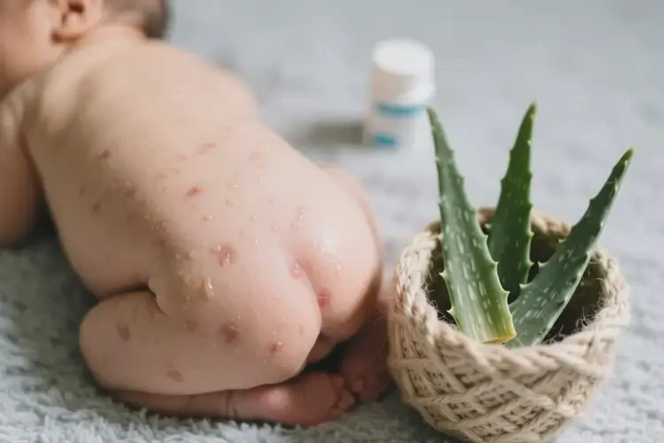 新生兒屁股上長濕疹可不可以根治(圖1)