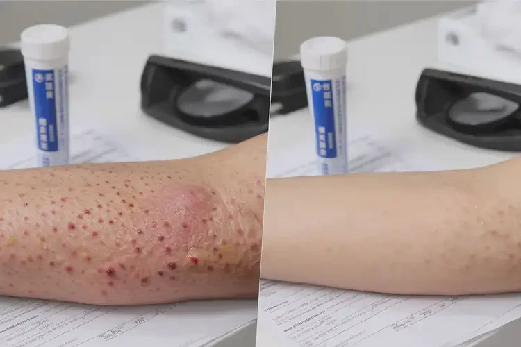 老年人全身起濕疹可不可以根治(圖3)