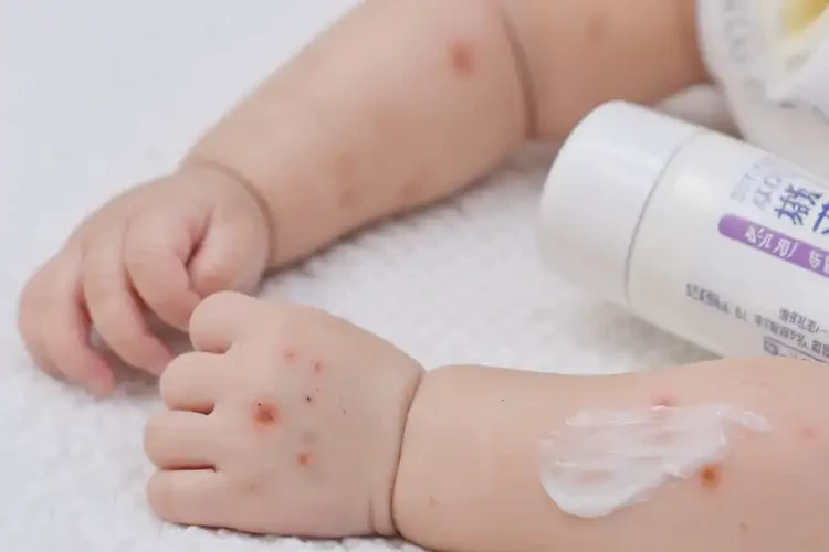 新生兒手臂有濕疹可不可以根治(圖3)
