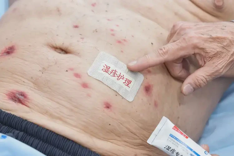 老年人肚子偶爾起濕疹可不可以根治(圖4)