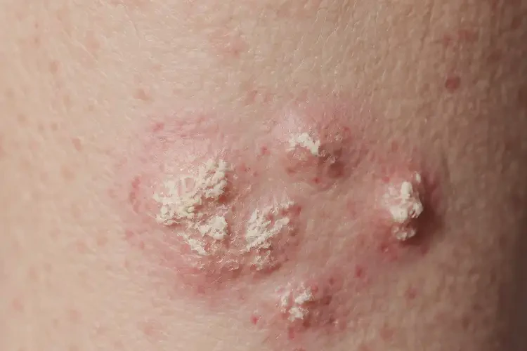 男人大腿經(jīng)常起濕疹能不能根治(圖4)