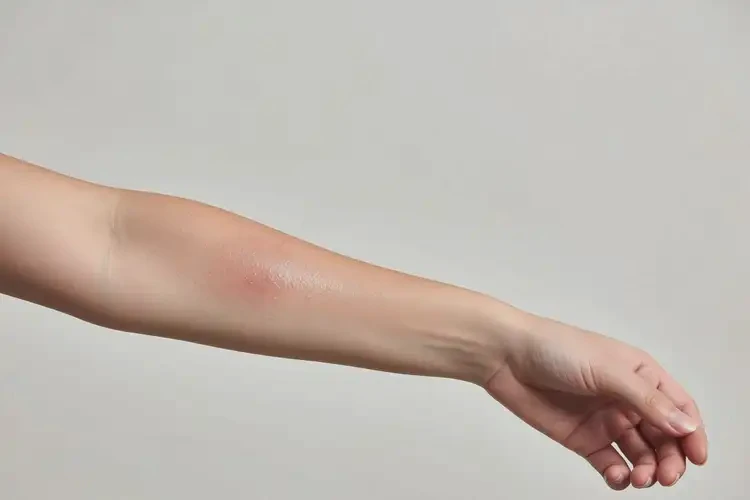女生手臂上偶爾長(zhǎng)濕疹可以徹底自愈嗎(圖4)