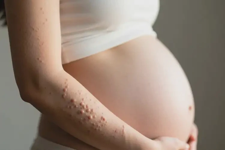 產(chǎn)婦手臂上容易起濕疹可不可以根治(圖4)