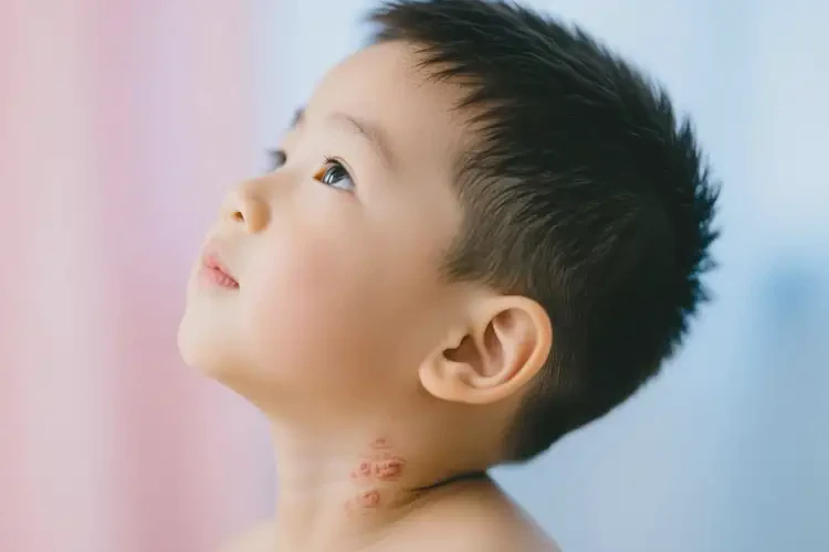 幼兒脖子經(jīng)常長濕疹能夠徹底治愈嗎(圖2)