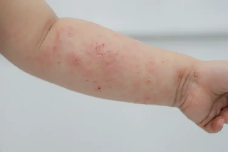 小孩手臂上起濕疹可以徹底自愈嗎(圖2)