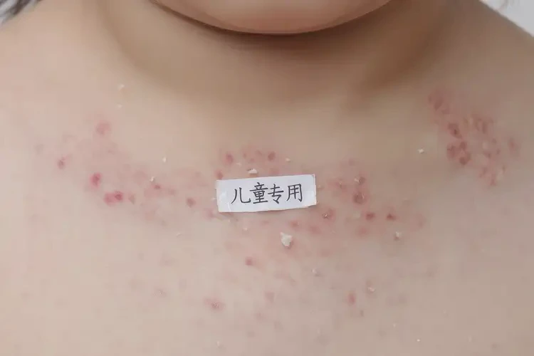 少兒脖子出現(xiàn)濕疹可不可以根治(圖4)