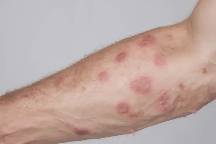 男性手臂上出現(xiàn)濕疹可不可以根治(圖4)