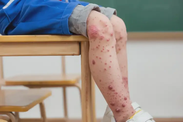 小學(xué)生小腿經(jīng)常起濕疹不管它會(huì)自己好嗎(圖4)