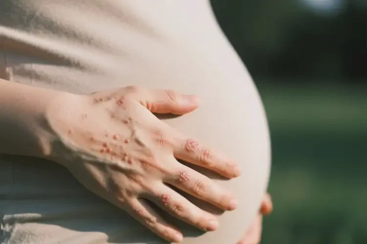 產(chǎn)婦身上出現(xiàn)濕疹可不可以根治(圖2)