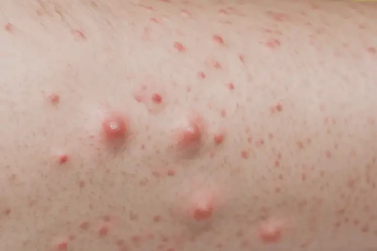 男生小腿上起濕疹可不可以根治(圖4)