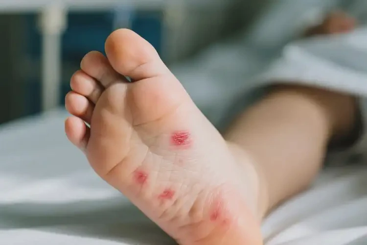 小孩腳上偶爾起濕疹可不可以根治(圖4)