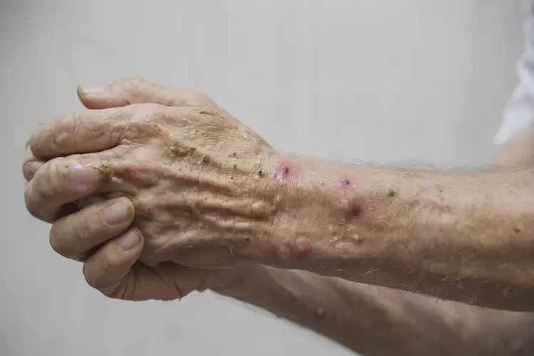 高齡老人手臂上出濕疹能不能根治(圖4)